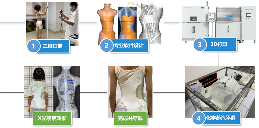 SLS 3D打印脊柱側彎矯形器制作流程